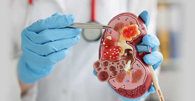 খালি চোখে কিডনি রোগ বোঝার উপায়