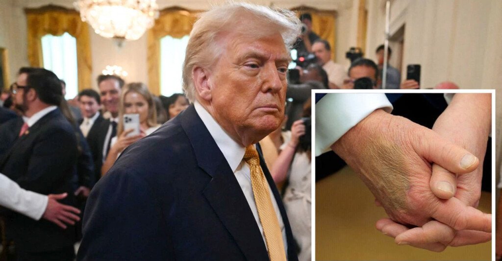 ট্রাম্পের হাতে কালশিটে, এক পা ফোলা, শিরার রোগে আক্রান্ত প্রেসিডেন্ট