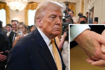 ট্রাম্পের হাতে কালশিটে, এক পা ফোলা, শিরার রোগে আক্রান্ত প্রেসিডেন্ট