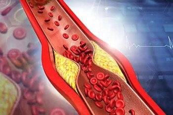 কোলেস্টেরল কমাতে উপকারী ভেষজ